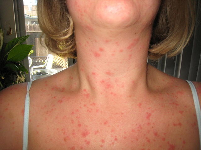 it's all over my neck and chest