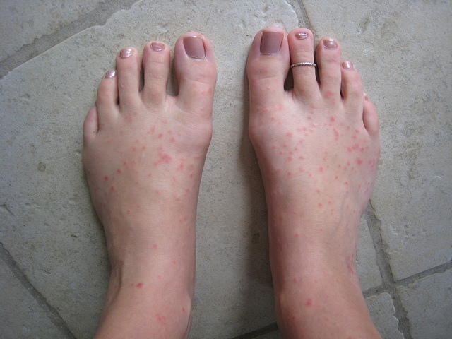 Feet on Wednesday - lots of little bumps