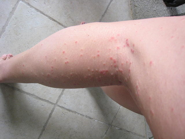 back of the leg is even worse