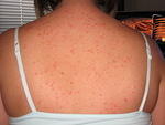 and my back too....looks like chicken pocks